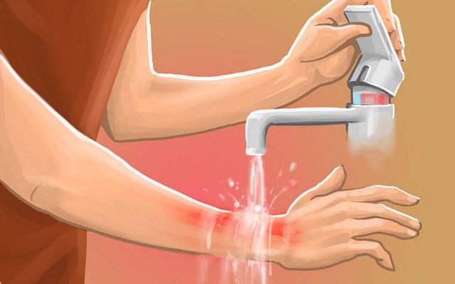 cách chữa bỏng nước sôi tại nhà