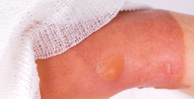 Với vết bỏng có diện tích rộng sâu tốt nhất bạn nên đến các cơ sở y tế để được thăm khám và điều trị.
